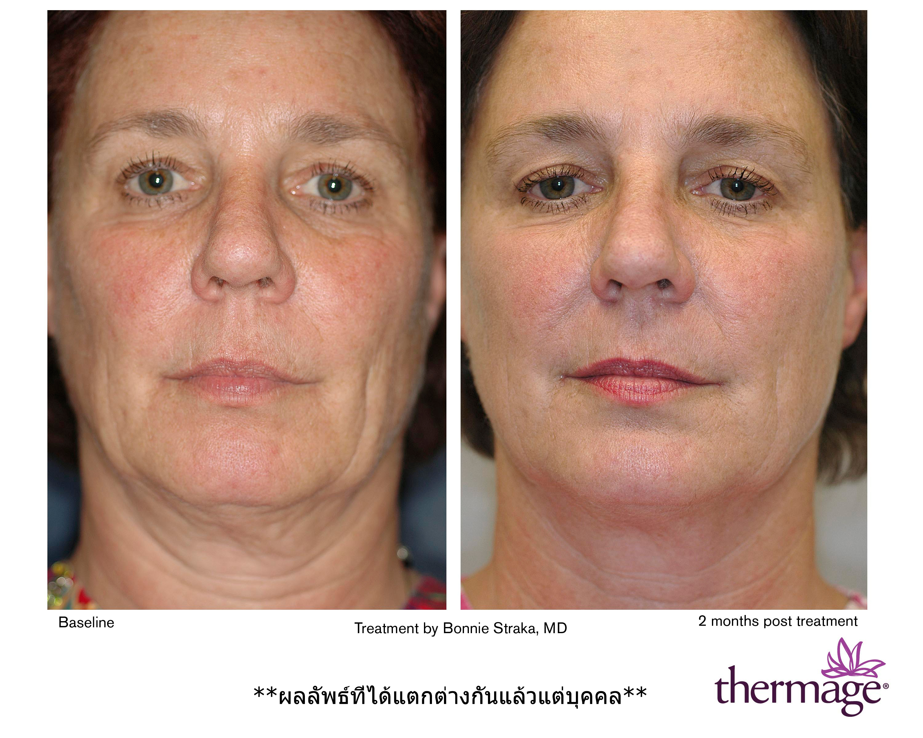 Lower face and neck treatment  by Bonnie Straka, MD. Pre and 2 month follow up. 1.5cm/4 passes/Level 62