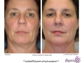 Lower face and neck treatment  by Bonnie Straka, MD. Pre and 2 month follow up. 1.5cm/4 passes/Level 62
