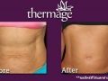 Thermage-this-one-.jpg