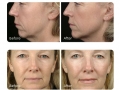 thermage-before-and-after.jpg