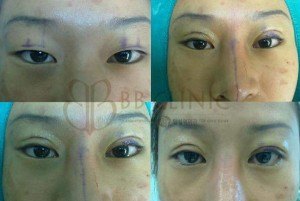 eyelids-surgery-korean-technique-2-300x201